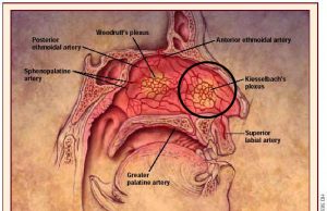어린이의 잦은 코피