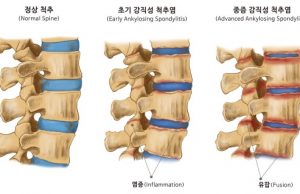 강직성 척추염