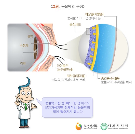 안구건조증4