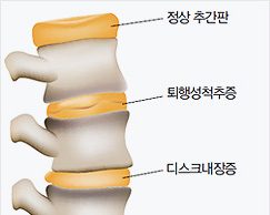 퇴행성 척추증