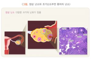 조기 폐경(조기 난소 부전증)