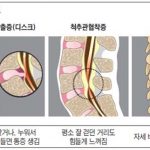 척추관협착증5