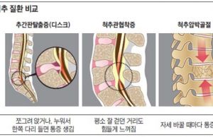 나이 들면서 심해지는 허리통증, 척추관협착증