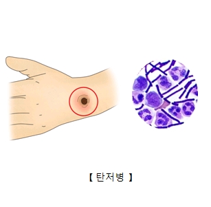 탄저병 증상과 세균. 그림 서울아산병원