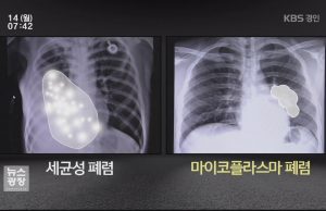 WHO, 中 마이코플라스마 폐렴 확산에 공식대응…”정보제출 요구”