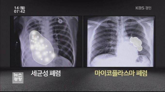 WHO, 中 마이코플라스마 폐렴 확산에 공식대응…”정보제출 요구”
