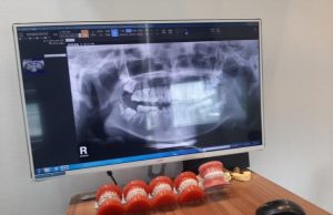 임플란트 부작용·진료비 환급 분쟁 증가…”전액 선납 주의해야”