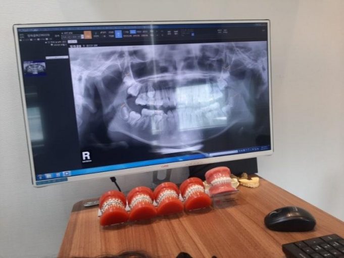 임플란트 부작용·진료비 환급 분쟁 증가…”전액 선납 주의해야”