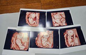 자연임신 다섯쌍둥이 탄생 ‘경사’ 세계적 드물어…. “집안에 한 반이 생겼네요”