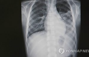 “요양병원 입원환자 100명에 5명꼴로 폐렴 발생”