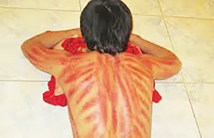 인도네시아의 민간요법